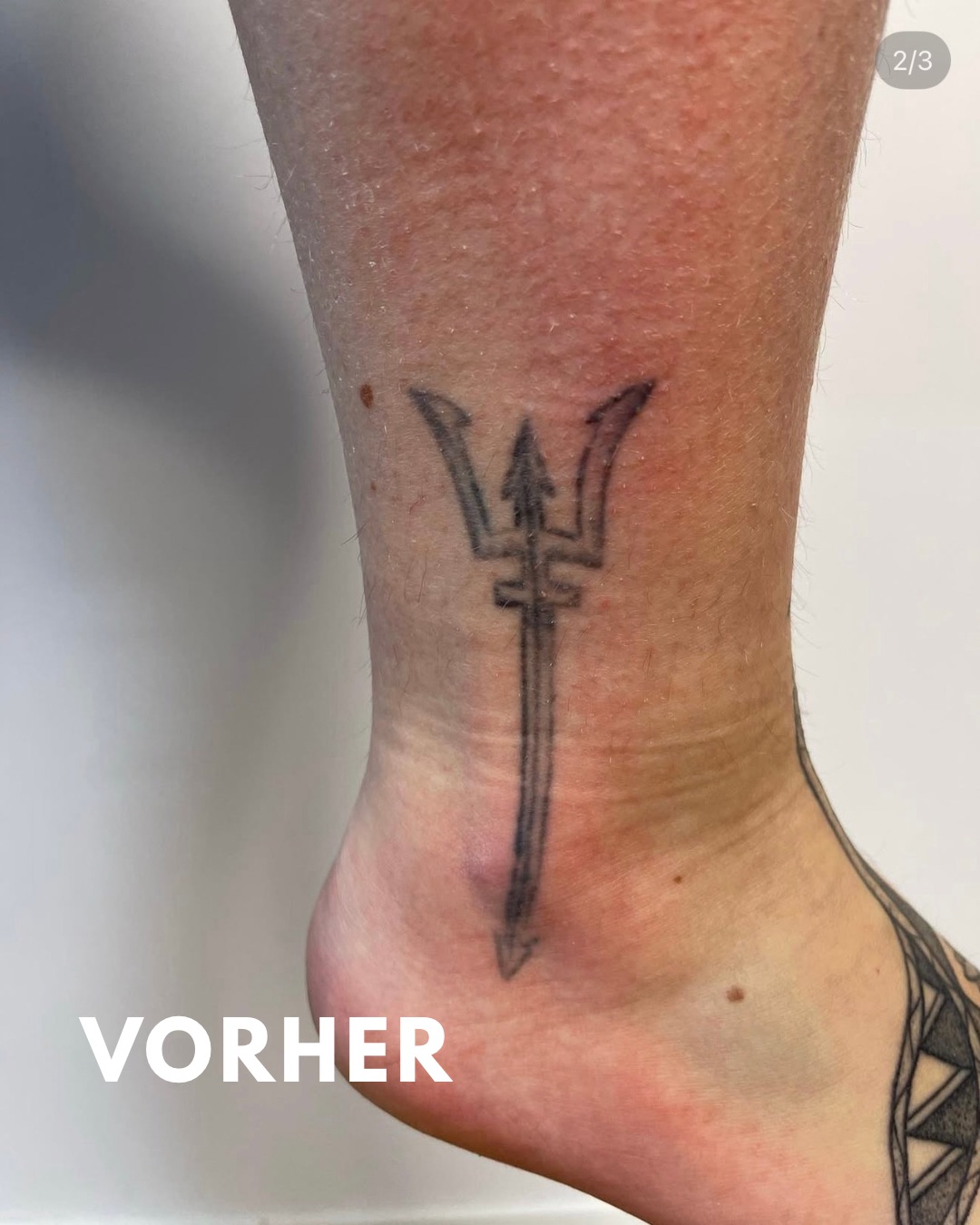 Vorher – Bein